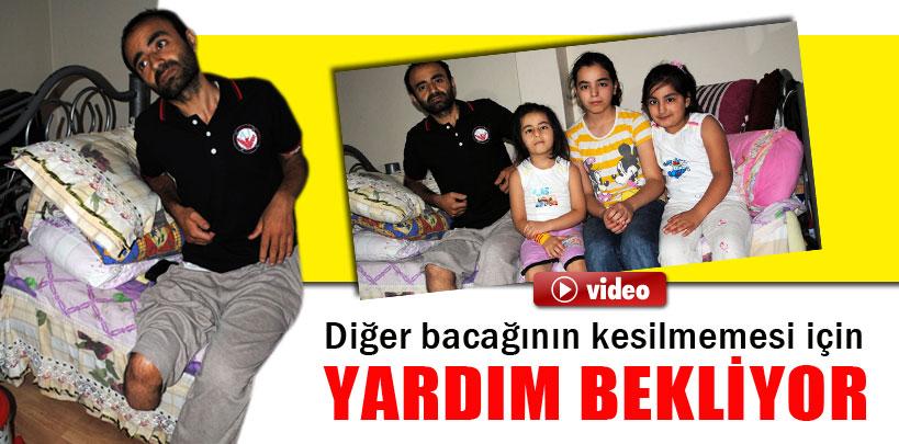 Burger hastalığına yakalanan baba yardım bekliyor