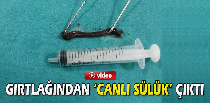 Hastanın gırtlağından 'canlı sülük' çıktı